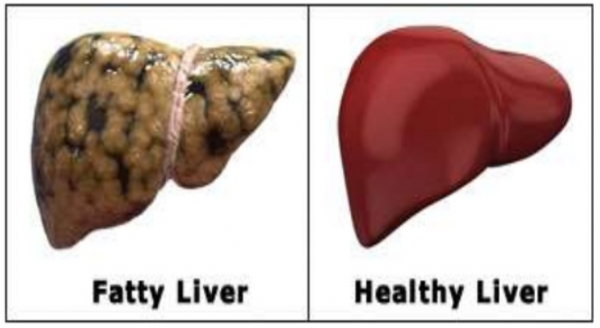 fatty-liver-the-next-enemy-singapore-medical-specialists-centre