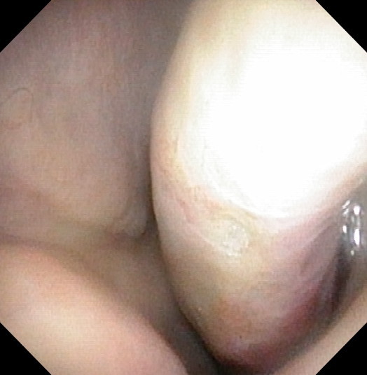 side wall tissue inside nose