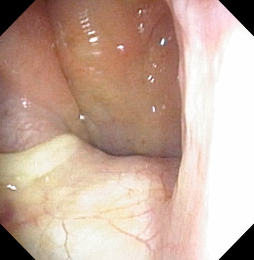 sinus infection photo