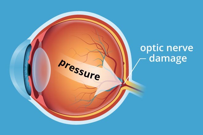 glaucoma-condition Glaucoma Condition